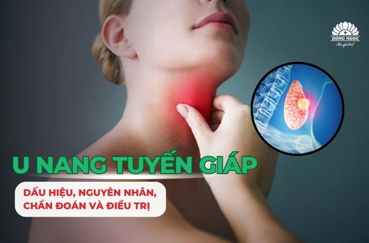 Tìm hiểu nang eo tuyến giáp là gì và tác dụng của nó đối với sức khỏe