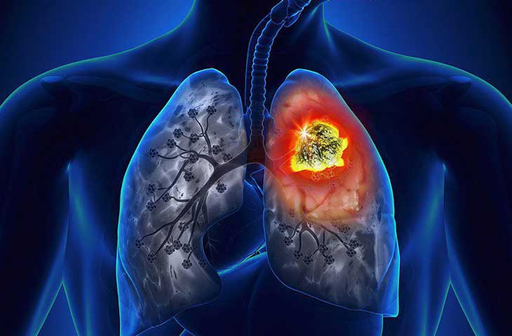 Các biến chứng COPD nổi bật nhất là gì?
