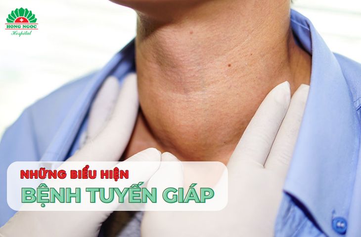 Bệnh tuyến giáp có phải bệnh mãn tính hay là bệnh tạm thời?
