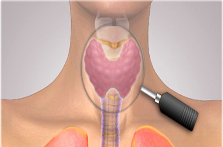 Điều trị nhân xơ tuyến giáp