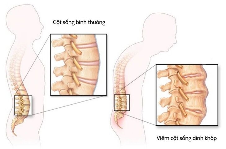 Vật lý trị liệu có thể kết hợp với các phương pháp điều trị khác để tăng cường hiệu quả không?
