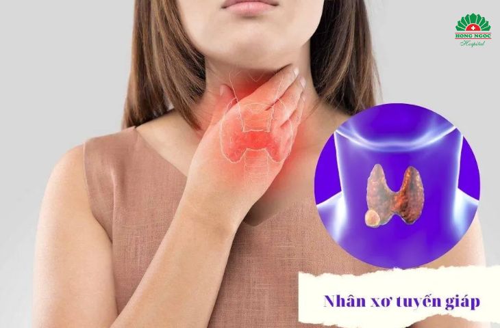 Nhân xơ tuyến giáp có nguy hiểm không