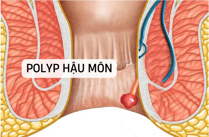 Polyp hậu môn là gì?
