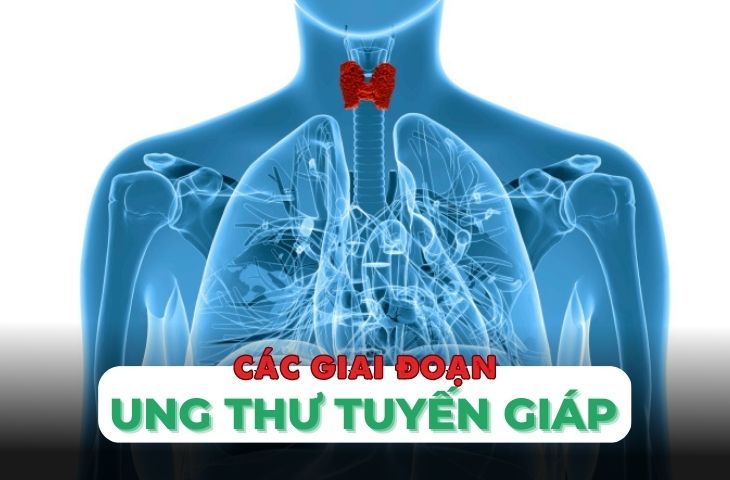 Tiên lượng sống còn của bệnh nhân ung thư tuyến giáp có liên quan đến giai đoạn mắc phải không?
