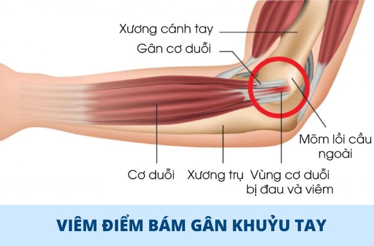 Viêm điểm bám gân khớp gối là gì?
