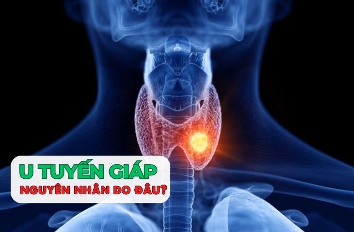 U xơ tử cung có liên quan đến bệnh u tuyến giáp hay không?
