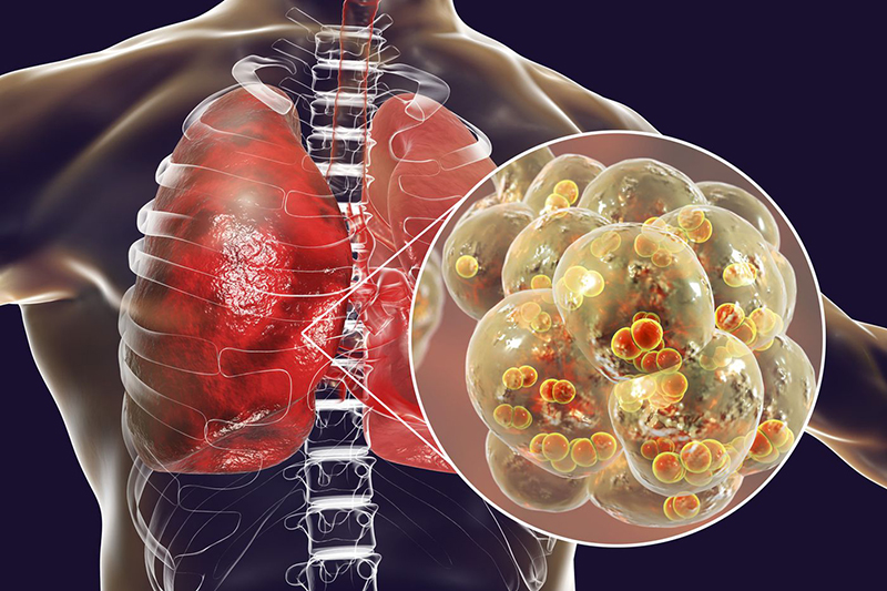Giữa vi khuẩn và virus, loại tác nhân gây viêm phổi cấp nào phổ biến hơn?
