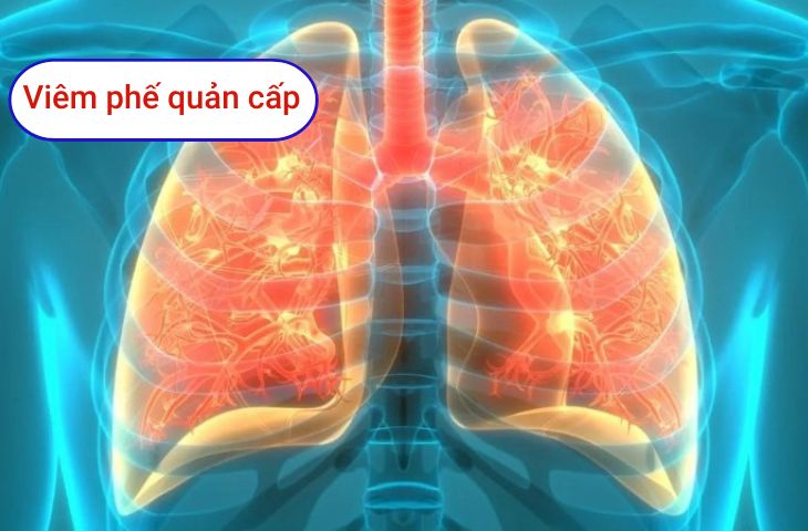 Viêm phế quản có thể lây qua đường tiêu hóa không?
