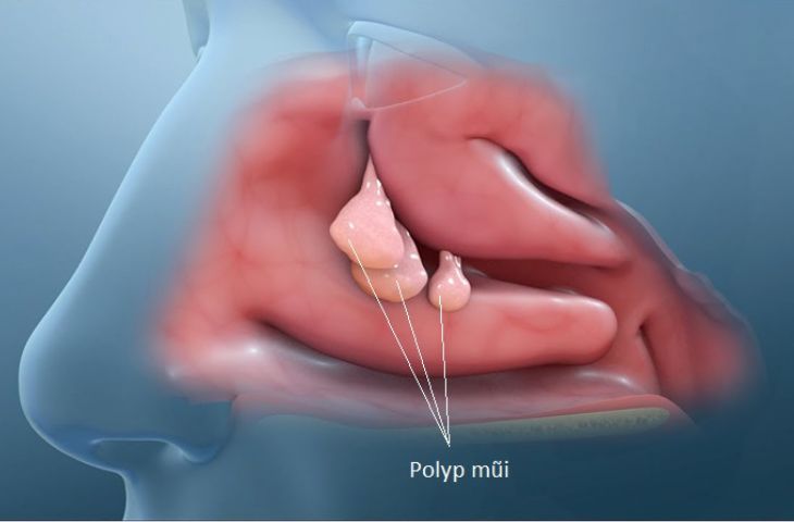 Bệnh nhân có polyp mũi cần được mổ xoang mũi