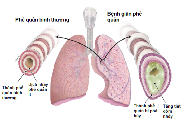 Những biến chứng có thể xảy ra nếu không chẩn đoán và điều trị giãn phế quản?
