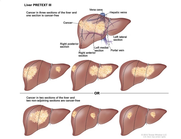 Ung thư gan giai đoạn 3 xuất hiện nhiều khối u hơn 