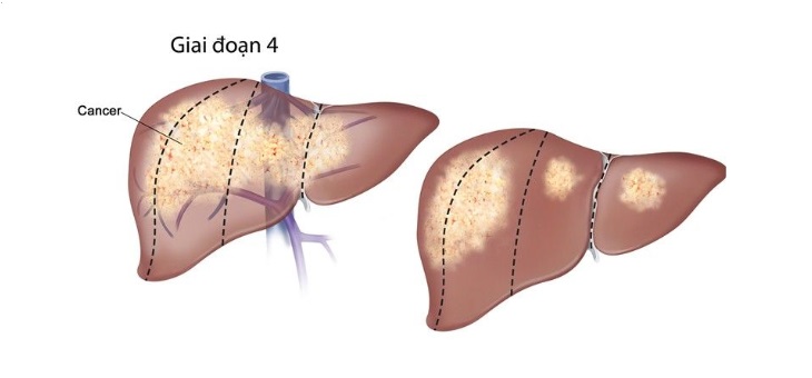 Ung thư gan giai đoạn 4 ảnh hưởng nghiêm trọng đến chức năng hoạt động của cơ quan