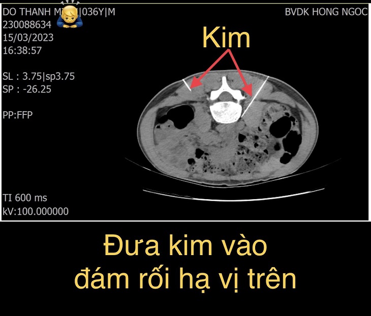 Can thiệp tiêm giảm đau cho bệnh nhân ung thư gan