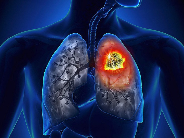 Ung thư gan thứ phát có thể do di căn từ ung thư phổi