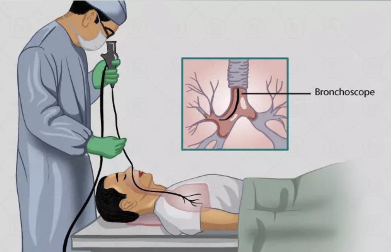 4. Những Lợi Ích và Nguy Cơ Của Nội soi Phế quản