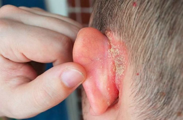Bệnh chàm tai là gì