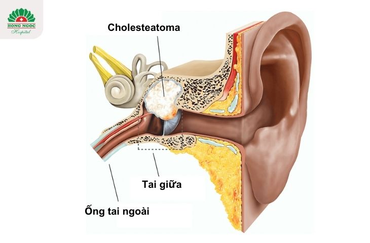 Khi nào cần phẫu thuật tiệt căn xương chũm