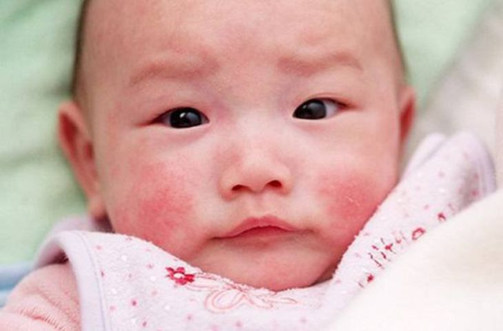 Trẻ vị dị ứng hoặc viêm da có thể dẫn đếnn chàm tai