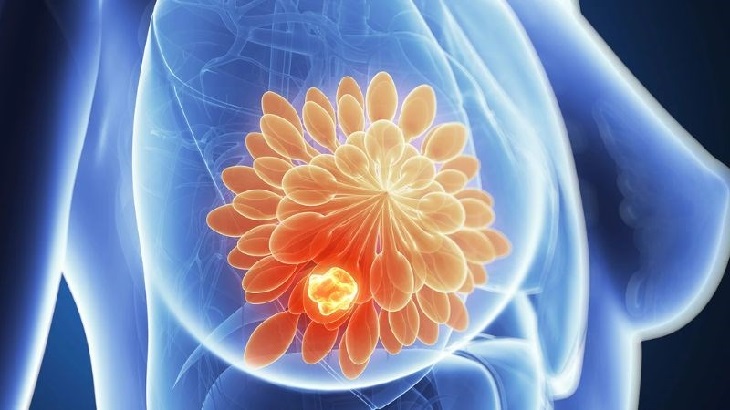 Tầm soát ung thư vú nên được thực hiện sớm ở phụ nữ từ 35 tuổi trở đi