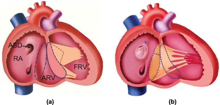 Bệnh Ebstein là dị tật tim bẩm sinh khi các lá van bị biến dạng và nằm ở vị trí quá thấp trong tâm thất phải