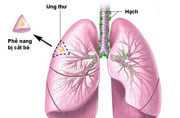 ung thư phổi