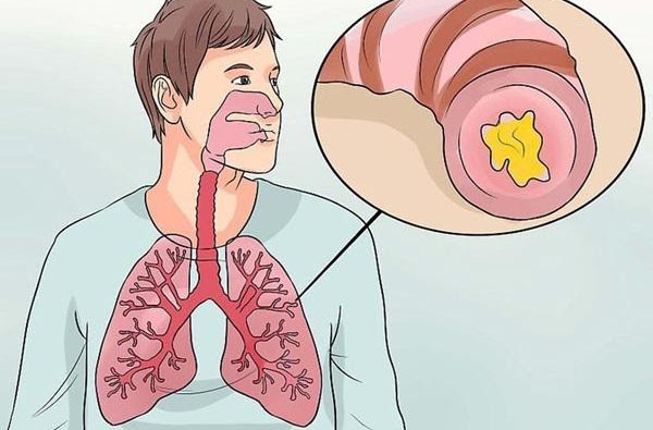 viêm phế quản mãn tính