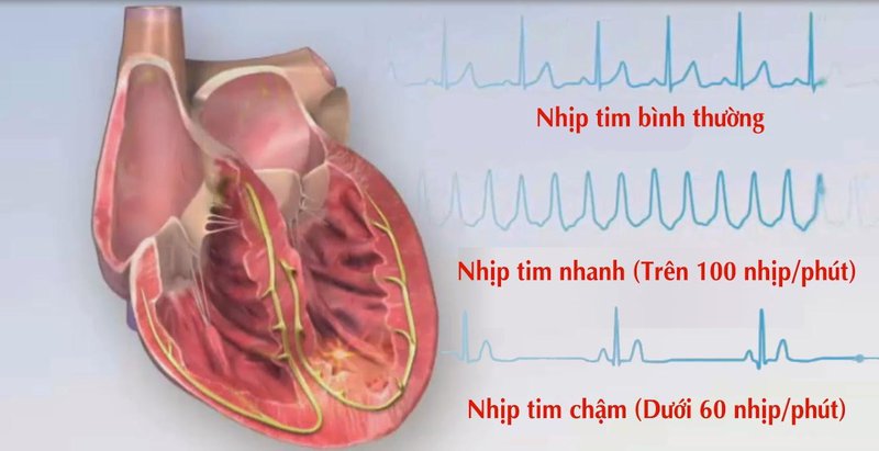 Nhịp tim chậm liên quan nhiều tới yếu tố bệnh lý