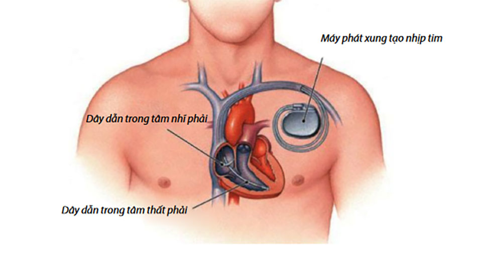 Máy tạo nhịp tim được đặt dưới vùng ngực giúp kiểm soát nhịp tim đập bình thường