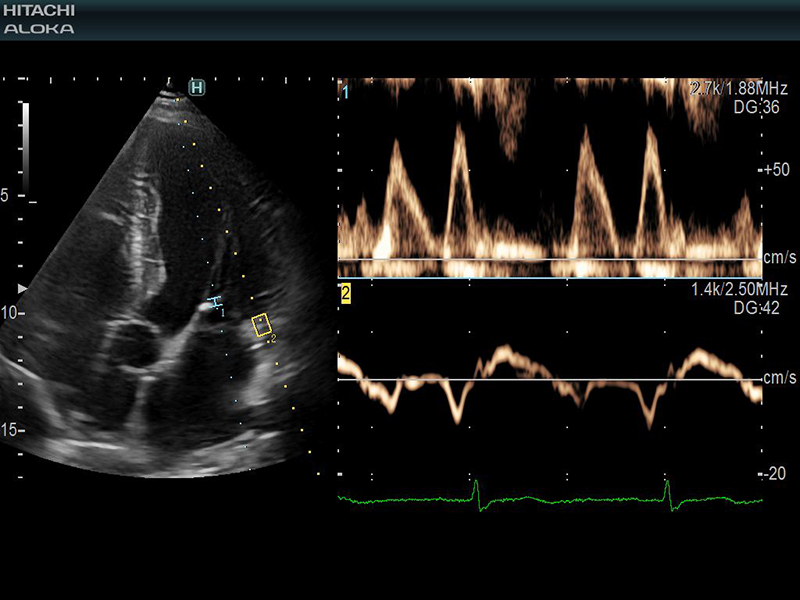 Nhịp tim được hiển thị rõ ràng trên hình ảnh siêu âm tim