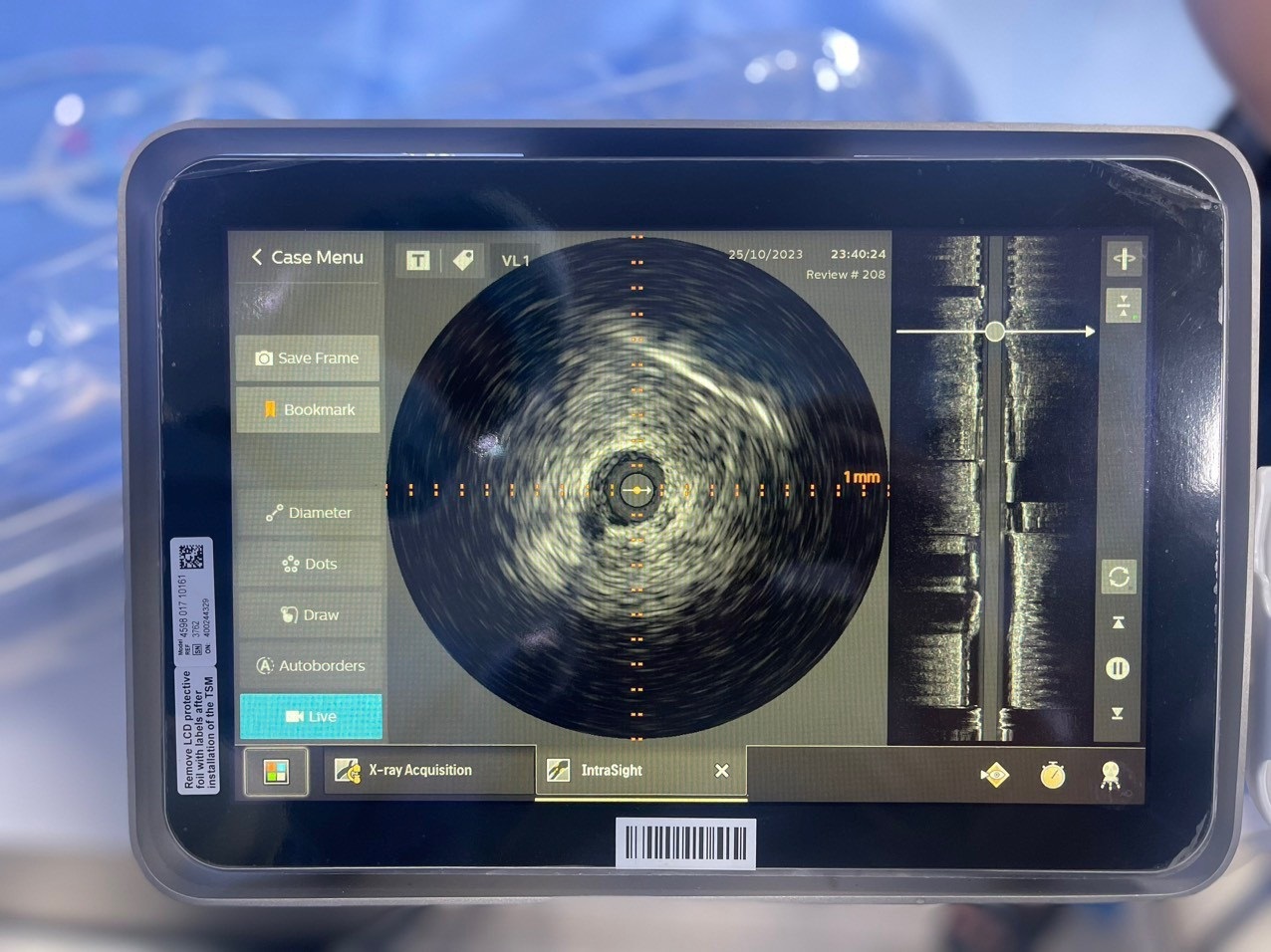 Siêu âm trong lòng mạch được ứng dụng thành công trong đặt stent mạch vành tại Bệnh viện Đa khoa Hồng Ngọc 