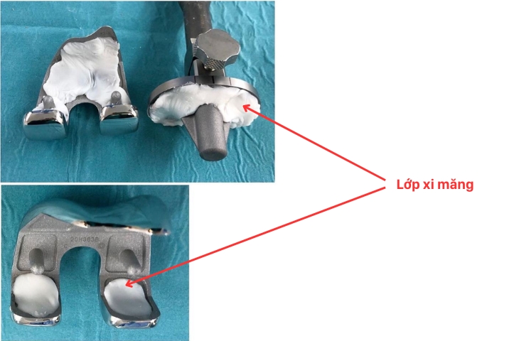 các loại khớp gối nhân tạo