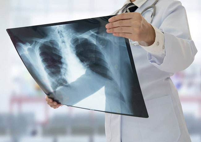 Chụp X-quang phổi thẳng là danh mục kiểm tra quan trọng trong tầm soát đột quỵ