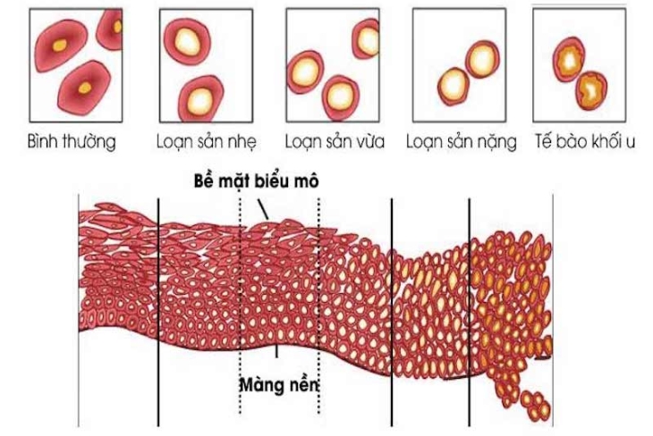 Loạn sản cổ tử cung