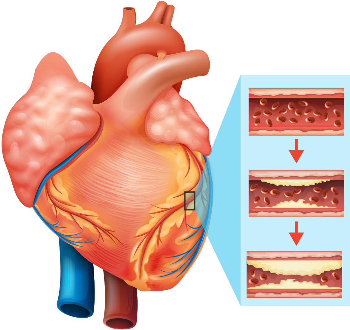 Suy tim là biến chứng tim mạch nguy hiểm, đe dọa tới sức khỏe và tính mạng của bệnh nhân