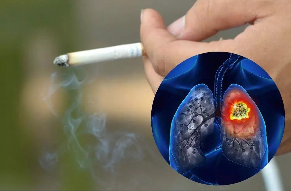 chụp CT phổi liều thấp