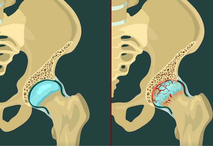 thay khớp háng ở bệnh viện nào tốt