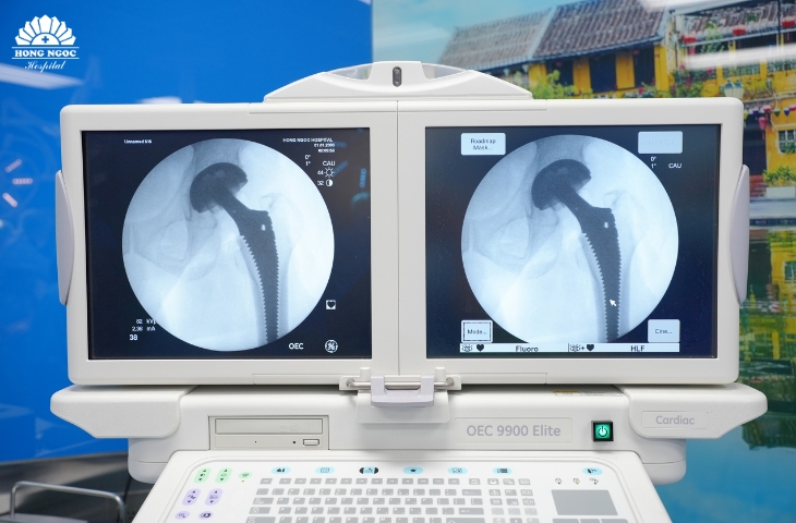 thay khớp háng toàn phần